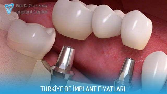 Türkiye’de implant fiyatları içeriğine ait görsel